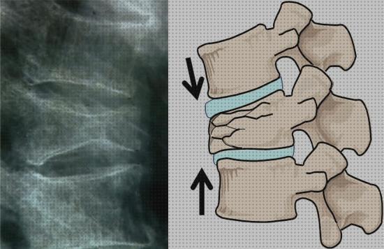 ¿Dónde poder comprar fractura corset ortopedico para fractura vertebral?