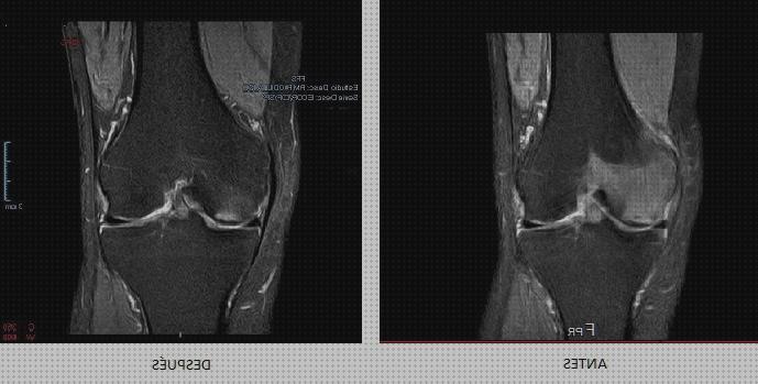 Análisis de los 22 mejores Edemas Oseo Rodillas Rehabilitacion