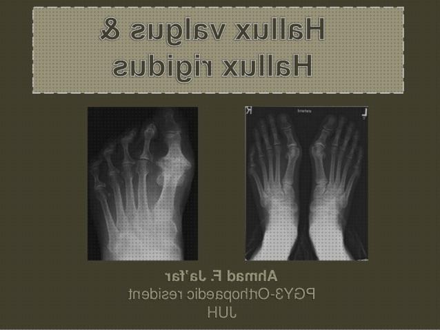 Las mejores marcas de zapato ortopédico hallux cifosis correccion ortopédica menton corset ortopédico cifosis hallux valgus hallux rigidus