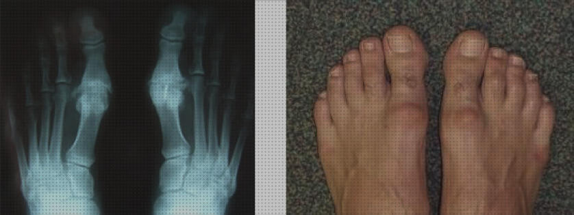 Review de hallux valgus hallux rigidus