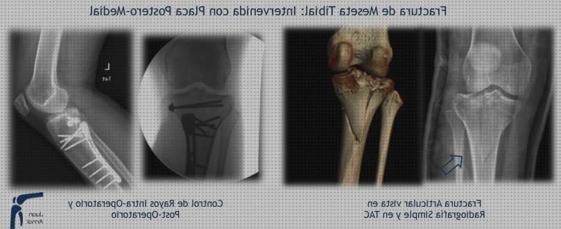 Las mejores marcas de fractura ortesis ortesis fractura meseta tibial