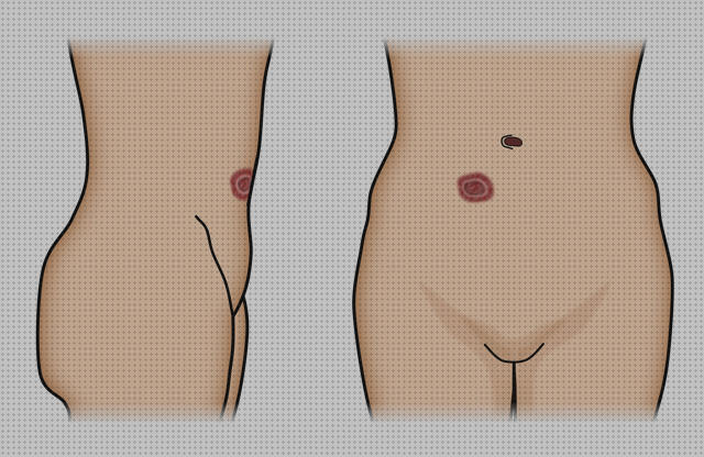 Los 11 Mejores artículos para ostomia temporales