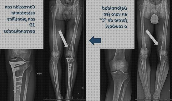 Review de plantillas ortopedicas tibias varas