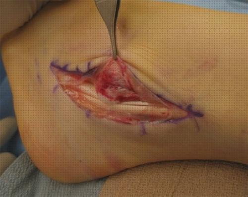 Las mejores marcas de tendon ortesis ortesis tendon peroneo