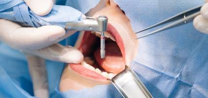 Prótesis sobre implantes dentales ¿Qué tipos hay y cómo son?